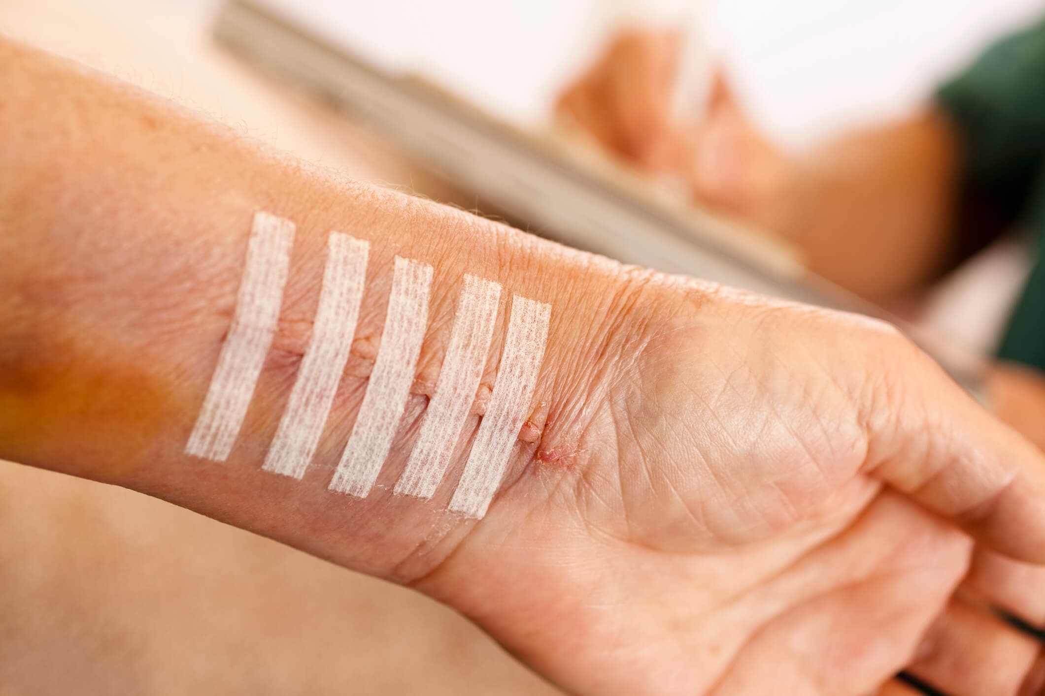 Como funciona a cirurgia de correção de cicatriz? Entenda aqui!